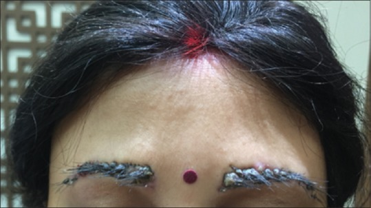negative reaction to artificial eyebrow grafts
