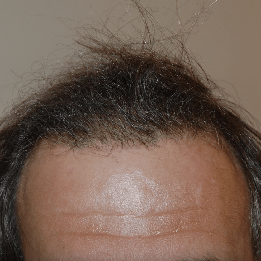 Norwood Stage 2 Photos, Treatments, Results Wimpole Clinic