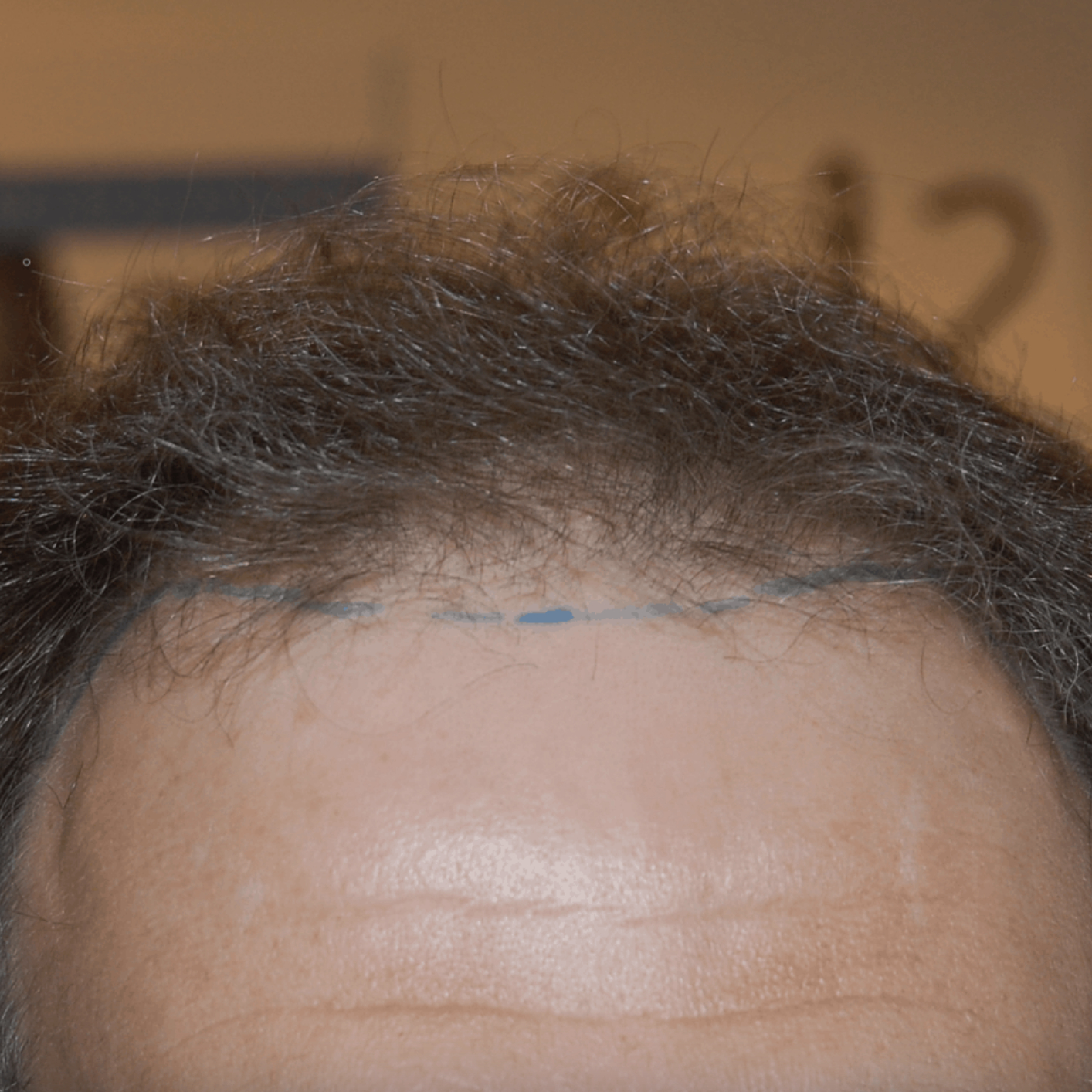 norwood 2 hair transplant - before