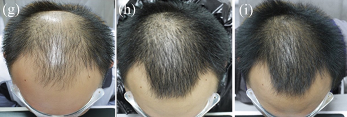 Improvement following Finasteride use at 6 and 12 months