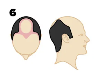 Example of stage 6 hair loss on the Norwood Scale