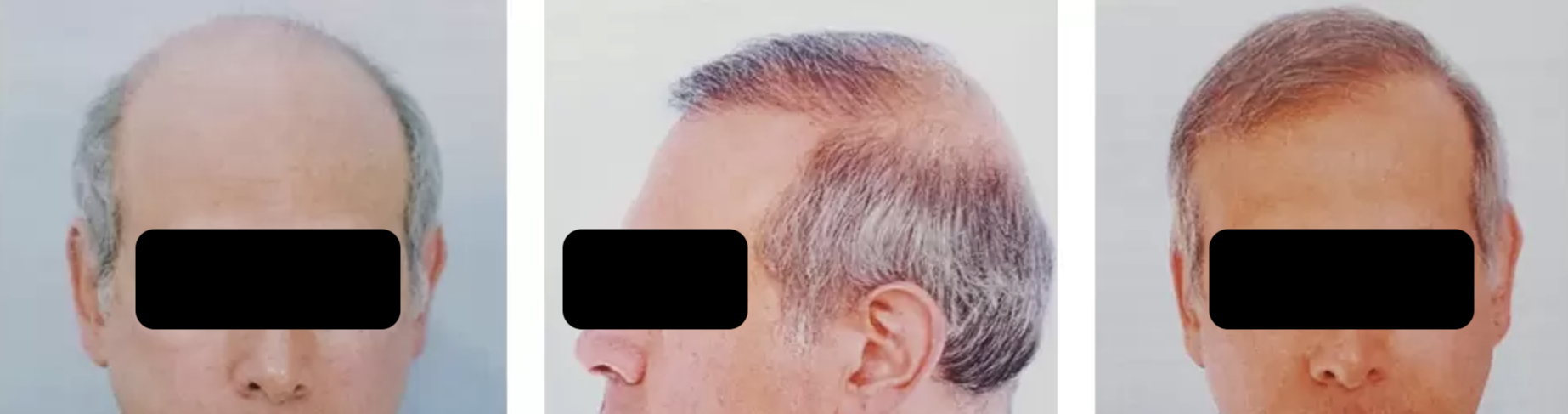 norwood 7 before and after hair transplant 2