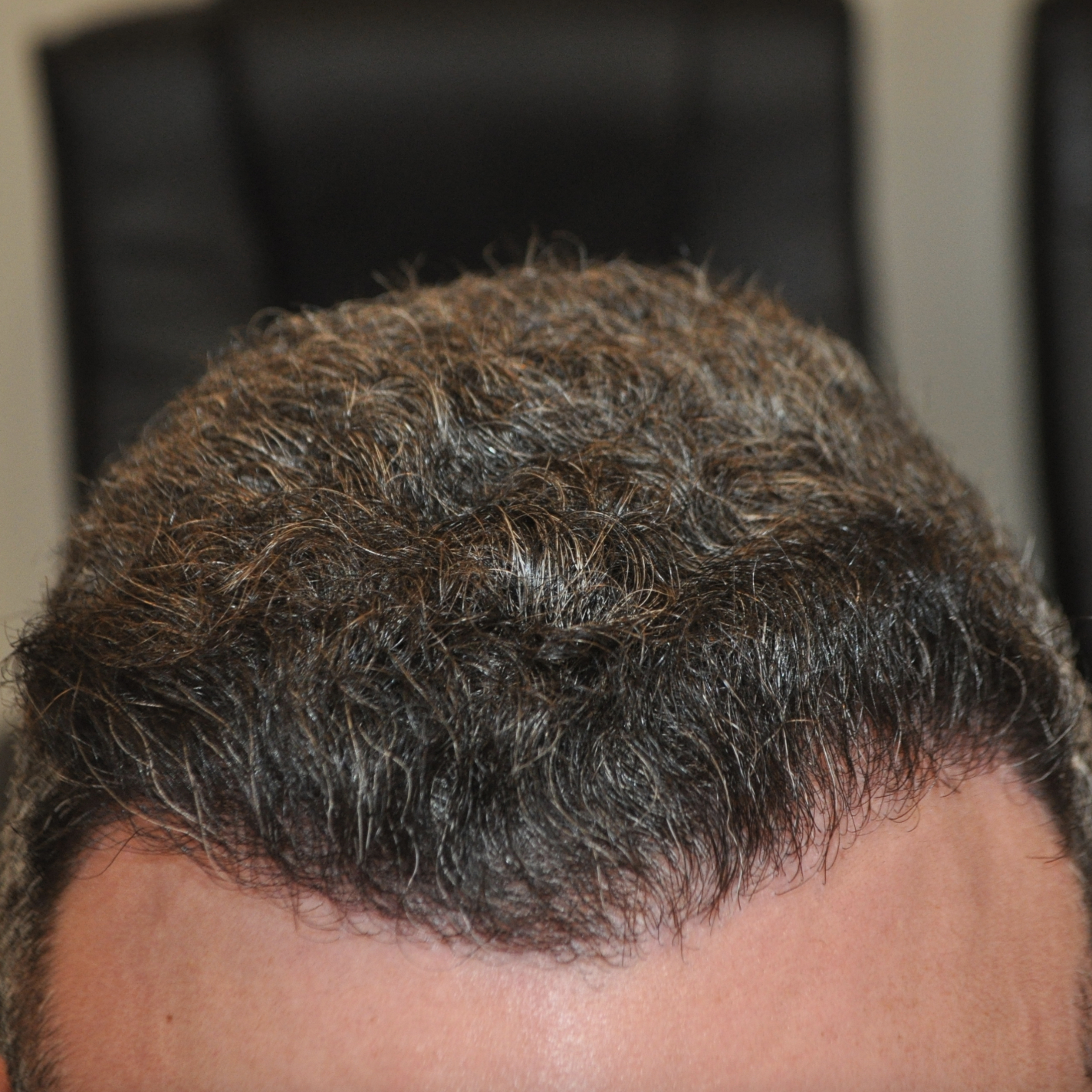 norwood stage 2 hair transplant - after