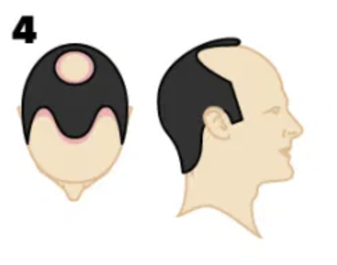 Informational graphic showing the level of hair loss people experience at Norwood stage 4