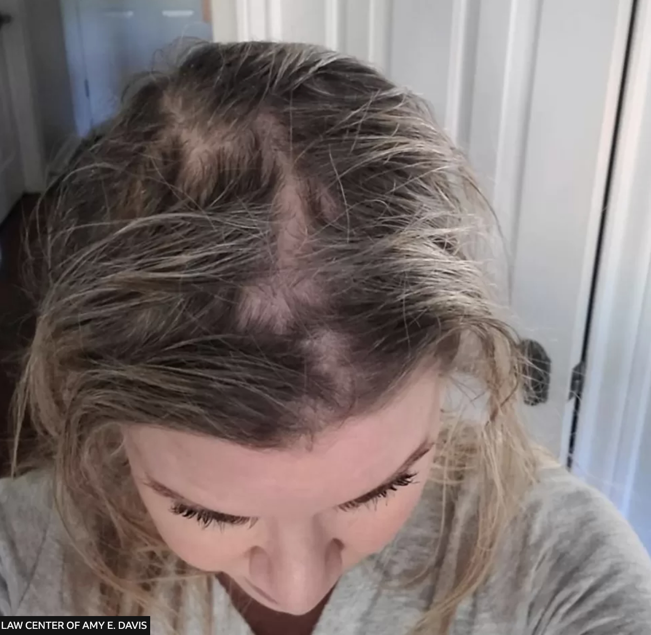 image from an individuals who claims to have suffered hair loss from Olaplex products