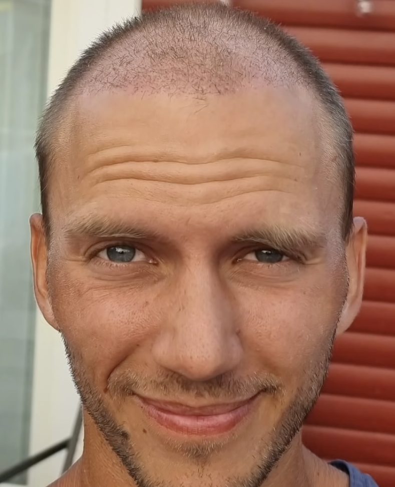 one month after hair transplant