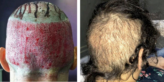 overharvesting results from a bad hair transplant