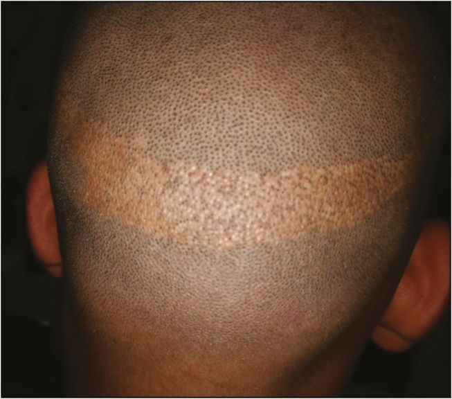 Visible scarring from extraction too many hair grafts from the donor area
