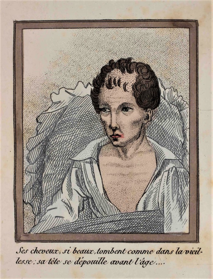 page from historic french medical journal suggesting hair loss is related to masturbation.