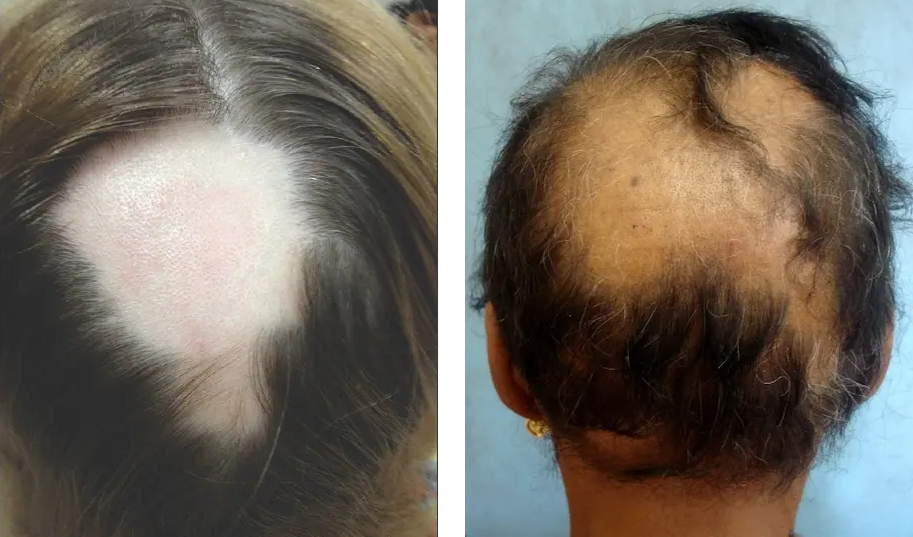 patchy hair loss on alopecia areata patients