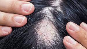 patchy hair loss on the scalp