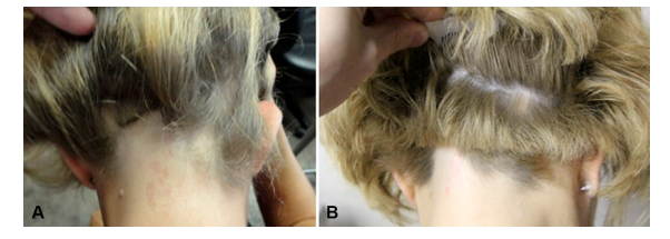 patient before and after PRP therapy for ophiasis alopecia