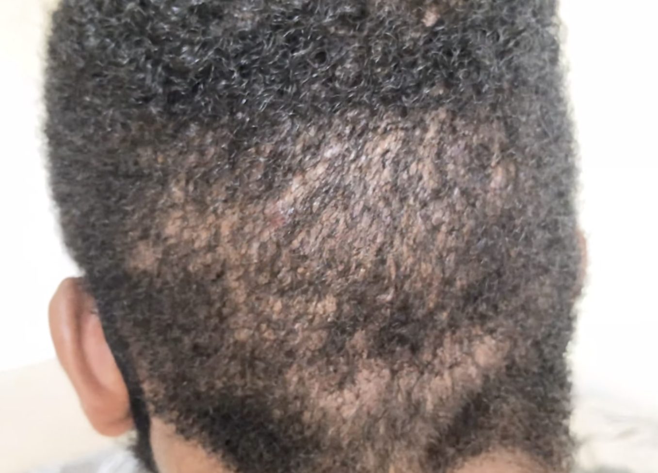 Donor area 2 months after hair transplant surgery