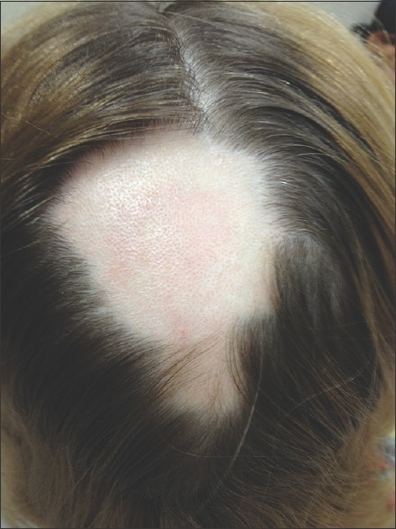 patient with alopecia areata 1