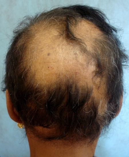 patient with alopecia areata 2