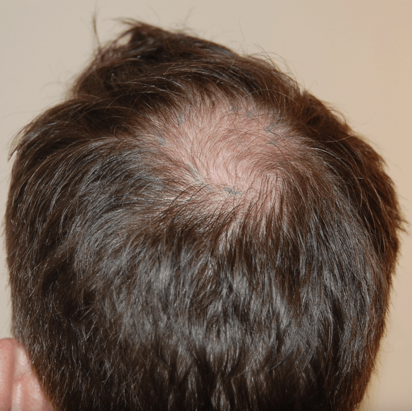 patient with norwood 3a stage balding