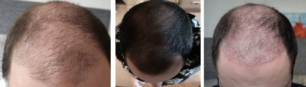 Patient before treatment (left), patient after 3 months of hair loss medication (center), patient 2 months after hair transplant surgery (right)