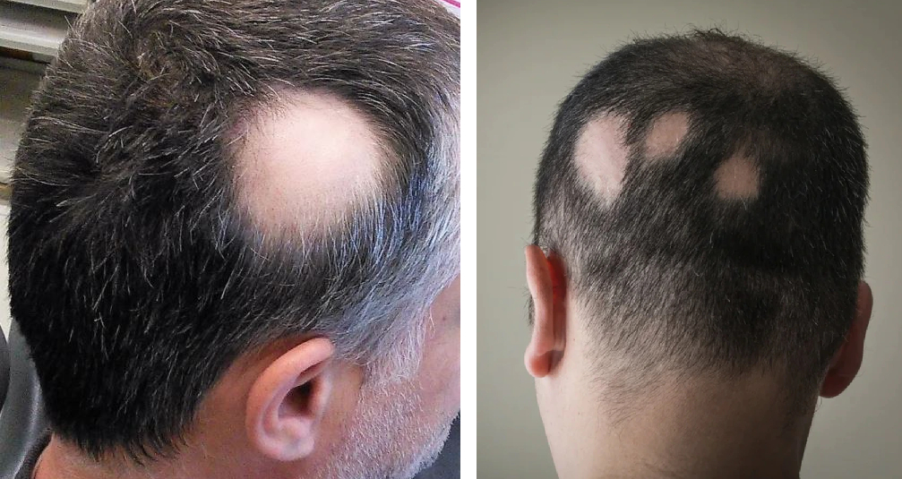 patients with alopecia areata