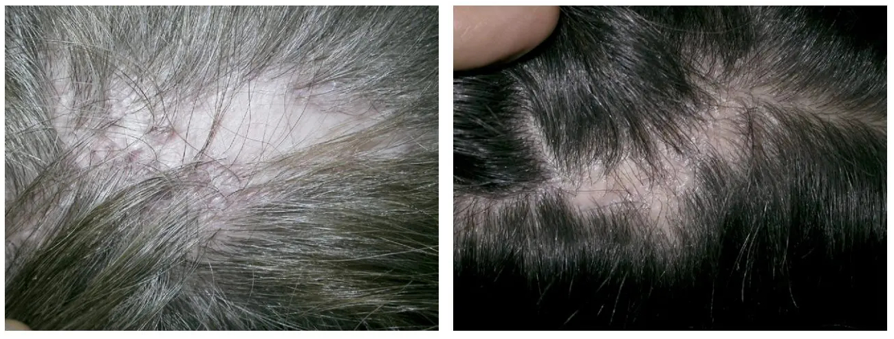 Scarring Alopecia: Causes, Stages &#038; Treatment Options, Wimpole Clinic