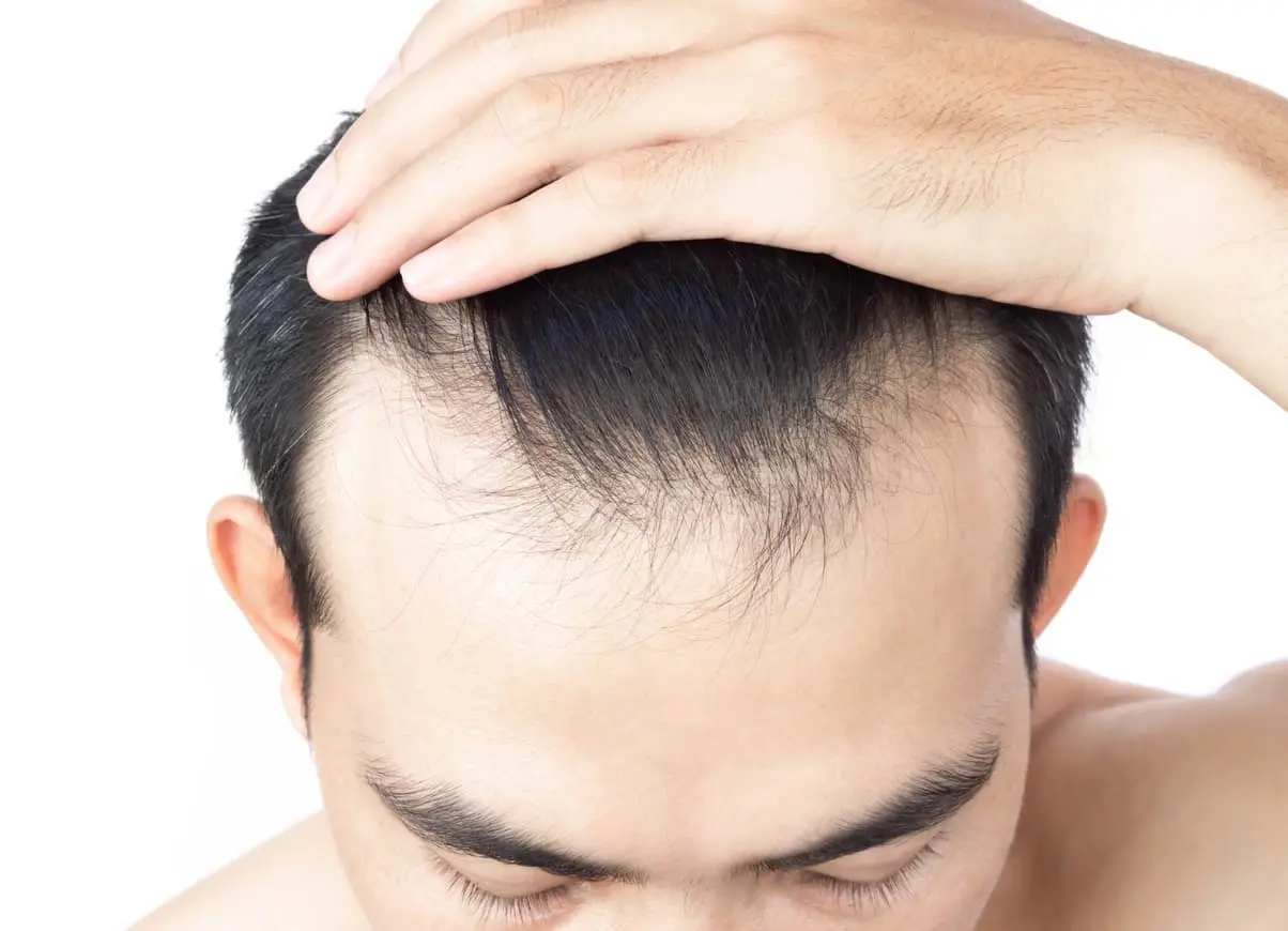 person pulling back their hair to show their hairline