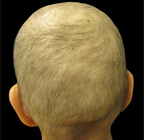 person with chemotherapy-induced alopecia