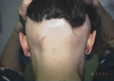 person with ophiasis alopecia