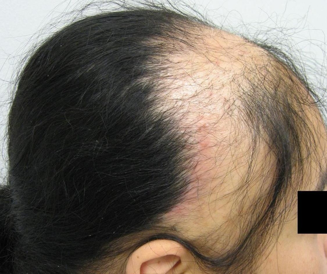 person with traction alopecia