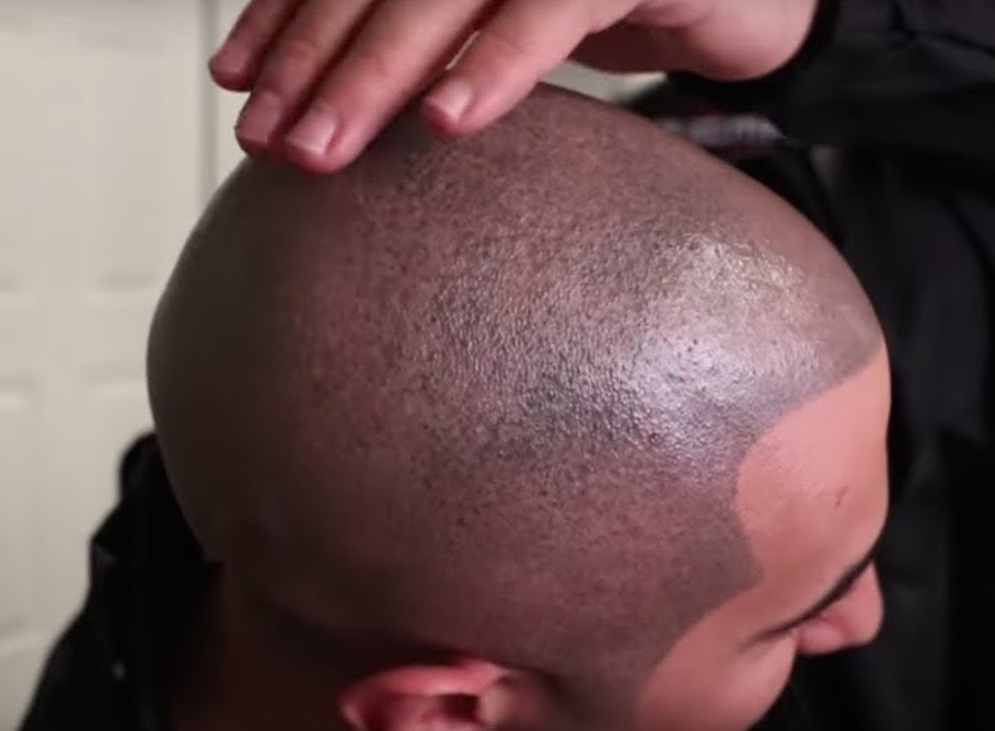 Encroaching scalp micropigmentation hairline with mismatched pigment