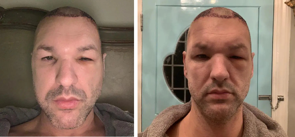 post hair transplant swelling in Wimpole Clinic patient