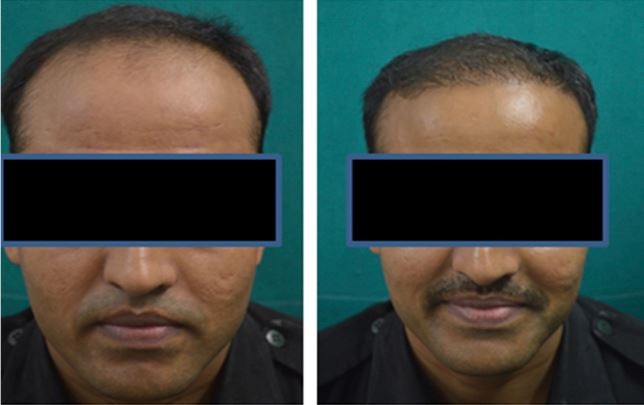 Hair before and 9 months after hair transplant