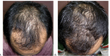 Finasteride Results: Timeline, Photos, Before & After