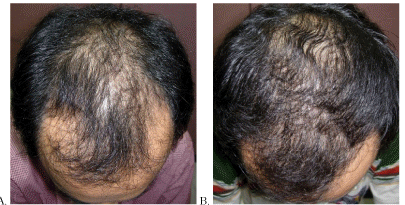 Before and after Propecia results from 1 year of treatment