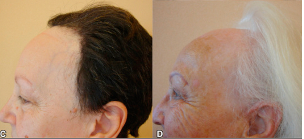 receding hairline caused by Frontal Fibrosing Alopecia