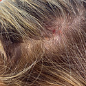 Recurring Scab On Scalp In The Same Spot: Causes, Prevention, Treatment