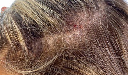 Recurring Scab On Scalp In Same Spot Featured Image
