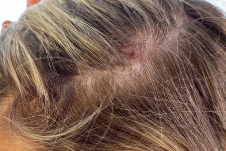 recurring scab on scalp in same spot featured image