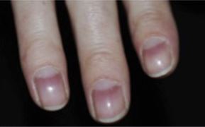 red nails alopecia areata