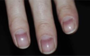 Alopecia Areata Nails