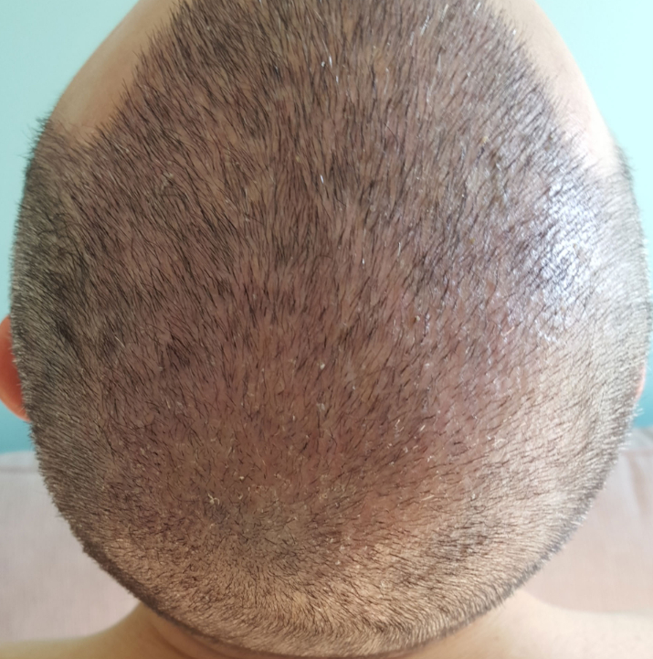 Redness beginning to die down 3 weeks post hair transplant