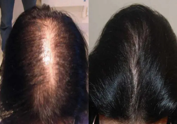 results after a FUT hair transplant