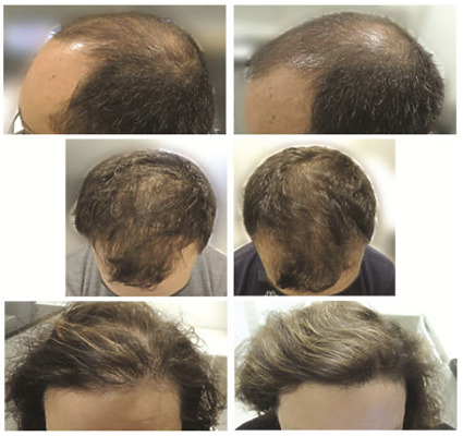 Can You Regrow Hair Naturally In 3 Weeks? 10 Fast Regrowth Tips