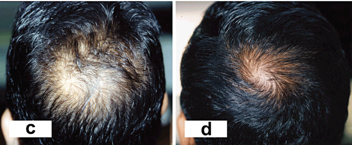 results from using Finasteride and Dutasteride together