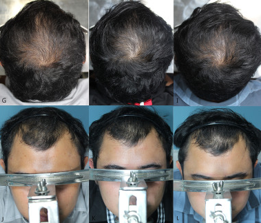 results of oral Minoxidil use after 6 months