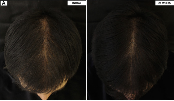 Results of taking low dose oral Minoxidil for 24 weeks in male pattern hair loss patient