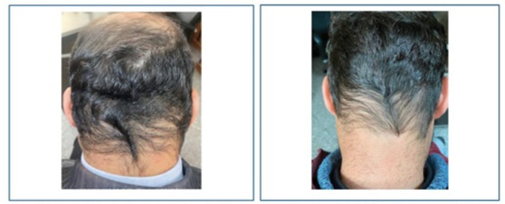 retrograde alopecia examples