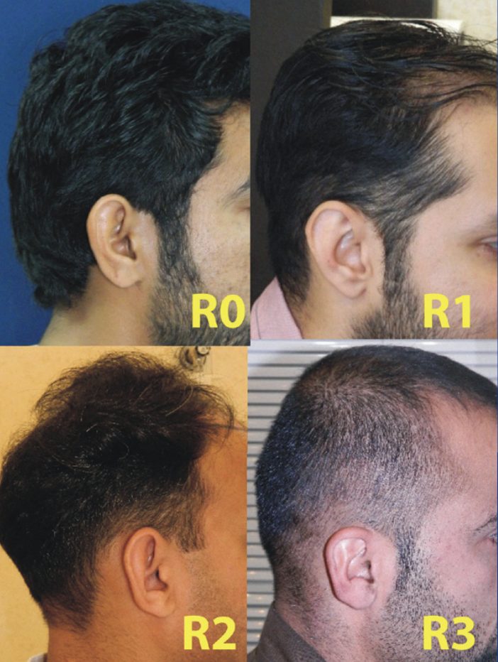 retrograde alopecia scale - 4 men with hair loss at the side of the head