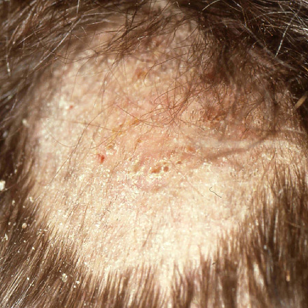 ringworm on scalp