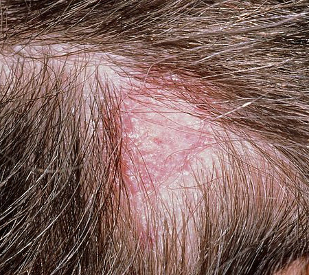 Recurring Scab On Scalp In The Same Spot: Causes, Prevention, Treatment ...