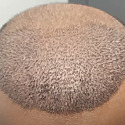 Hair Transplant After 10 Days: Photos, Results & Aftercare