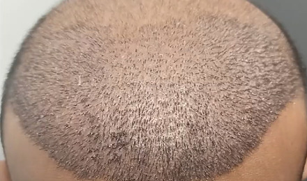 Scalp 10 Days After Hair Transplant Featured Image